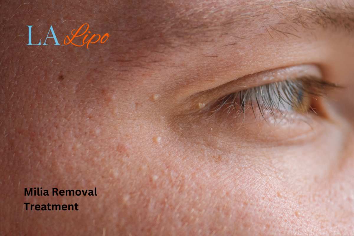 Cryopen Milia Removal: Is It the Easiest and Safest Option Chester-le-Street?