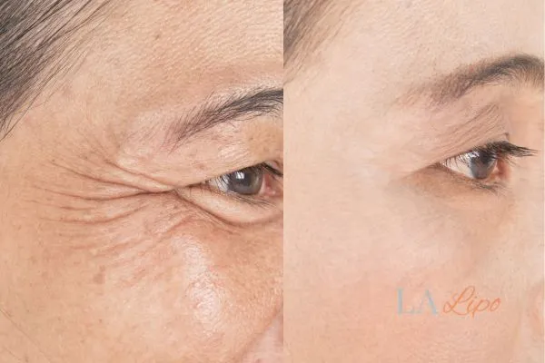 Before and after results of woman - HI-fu wrinkles reduction treatment Chester-le-Street