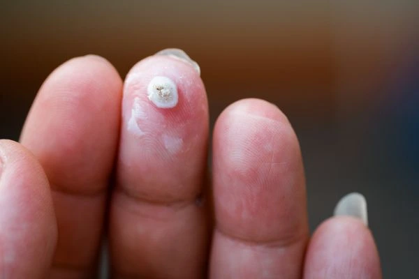 wart on person finger - cryotherapy to treat from LA LIPO Chester-le-Street