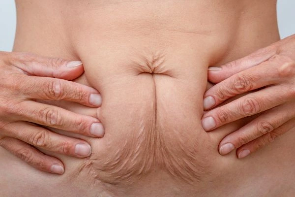 Should I Combine Diastasis Recti Treatment with Body Contouring for Better Results Chester-le-Street?